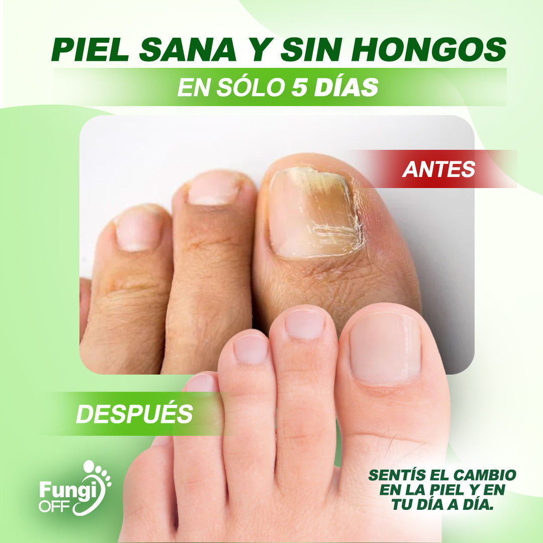 Spray FungiOff Acaba con los Hongos en 7 Días | LLEVA 3 PAGA 1