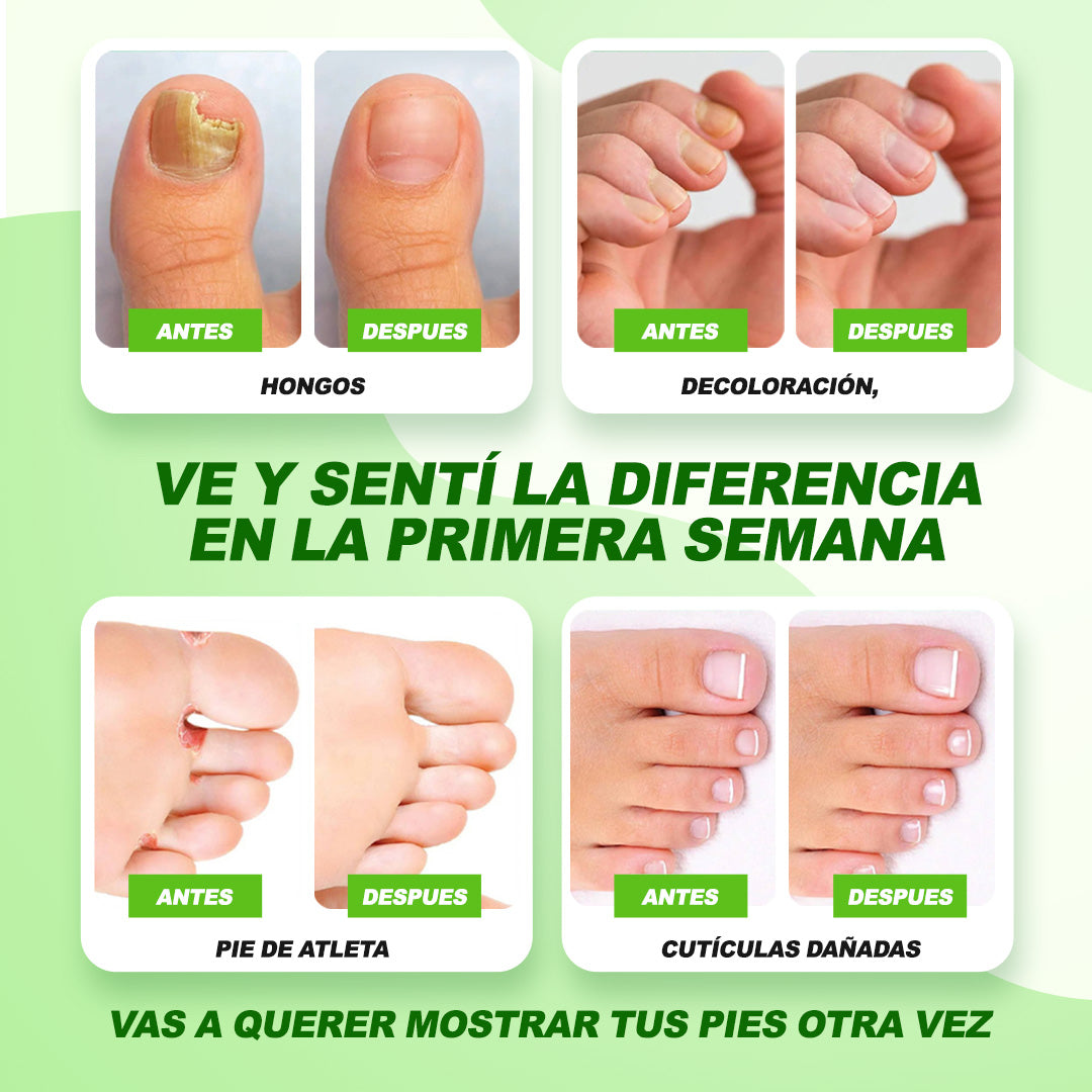 Spray FungiOff Acaba con los Hongos en 7 Días | LLEVA 3 PAGA 1